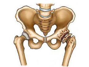 ce este artroza articulației șoldului