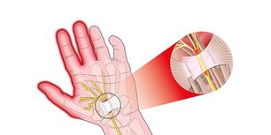 durere în articulațiile degetelor cu rizartroză
