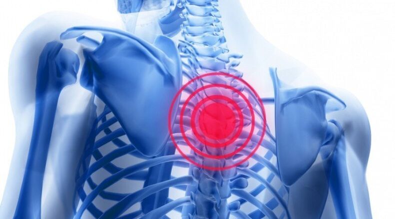 durerile de spate pot fi asociate cu o hernie de disc