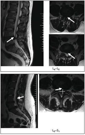 Scanarea RMN a herniei de disc a coloanei vertebrale