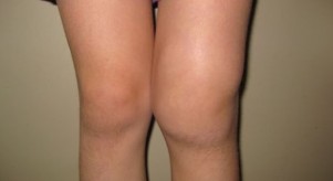 Deformarea genunchiului