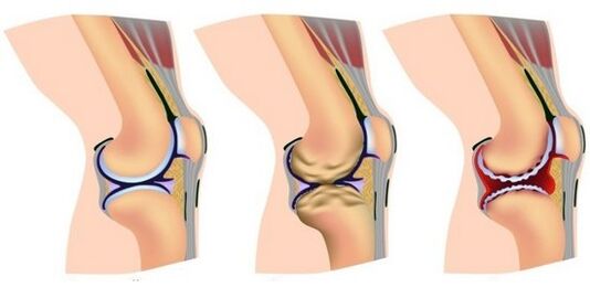 o articulație sănătoasă și durere în distrugerea articulației genunchiului