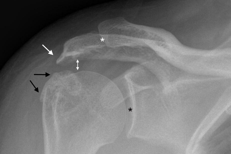 artroza articulației umărului la radiografie