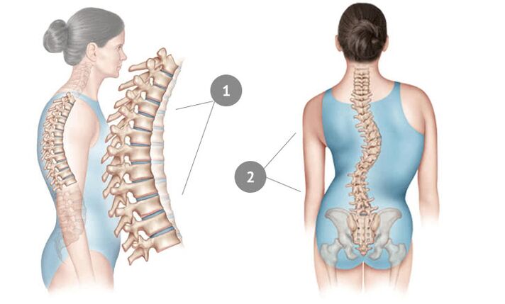 curbura coloanei vertebrale ca cauză a osteocondrozei toracice