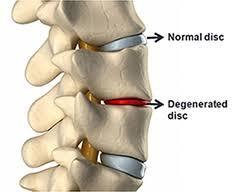 normal de disc a coloanei vertebrale, disc deteriorat
