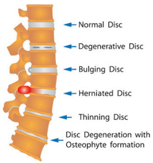 varietate de leziuni de disc a coloanei vertebrale